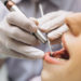 Perawatan Gigi yang Ditanggung BPJS Kesehatan